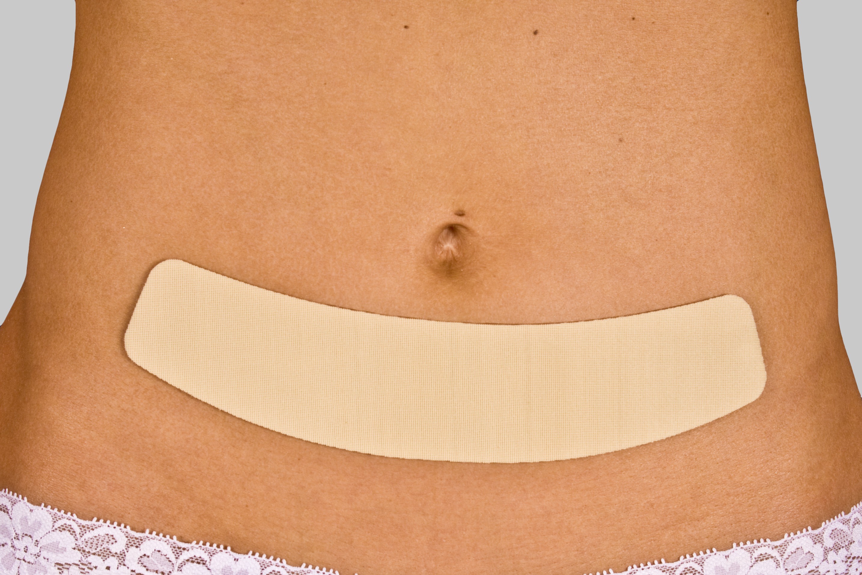 Дома расходится послеоперационный шов